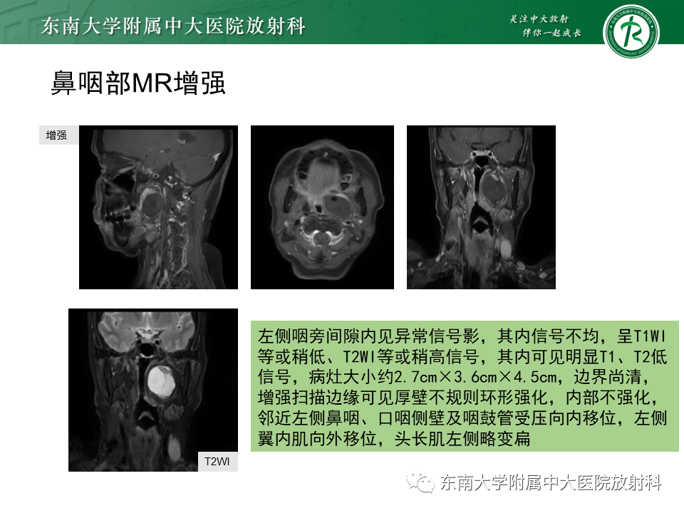 影像PPT - 【PPT】多形性腺瘤-26