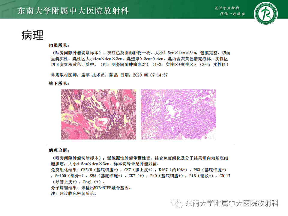 影像PPT - 【PPT】多形性腺瘤-27