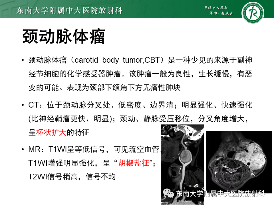 影像PPT - 【PPT】多形性腺瘤-28