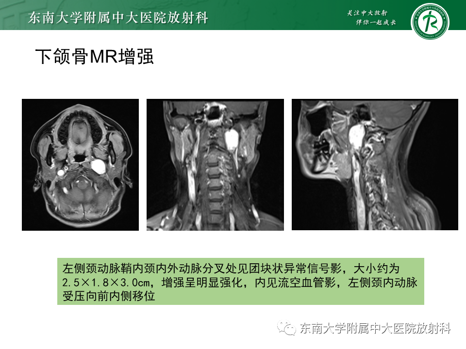 影像PPT - 【PPT】多形性腺瘤-30