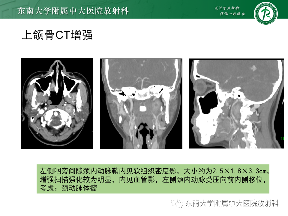 影像PPT - 【PPT】多形性腺瘤-31
