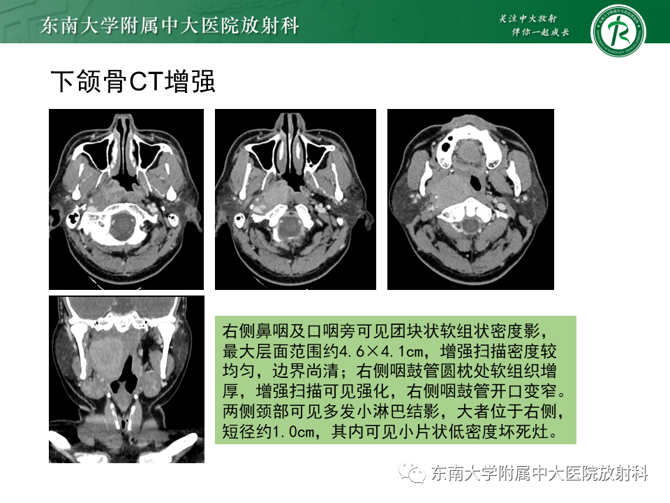 影像PPT - 【PPT】多形性腺瘤-33
