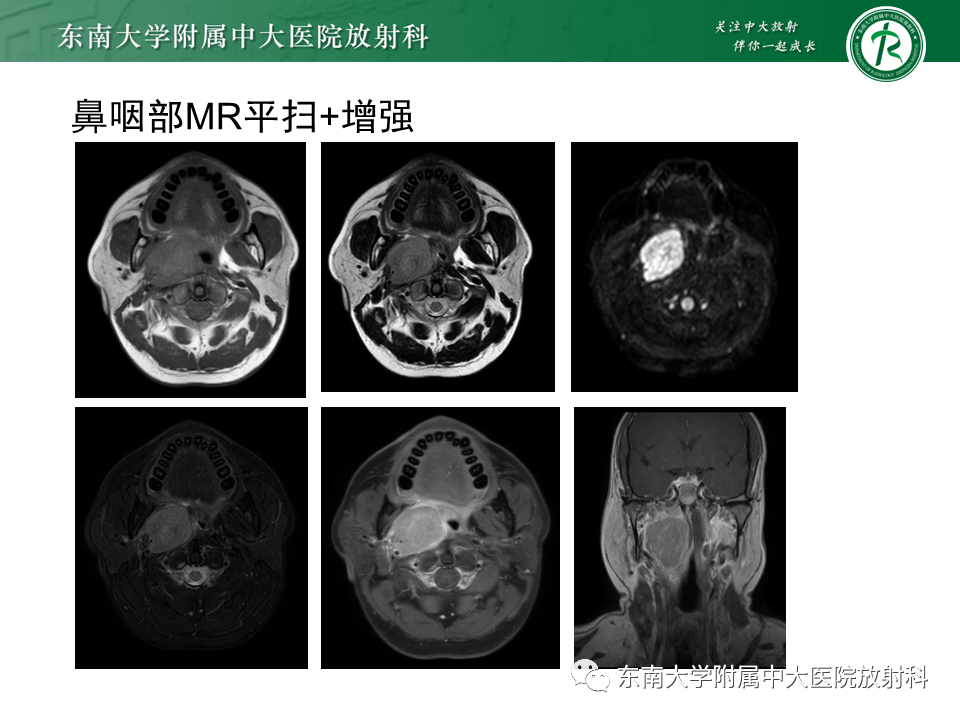 影像PPT - 【PPT】多形性腺瘤-34