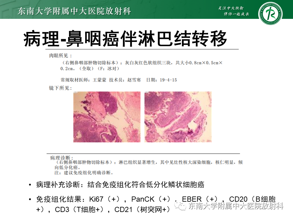 影像PPT - 【PPT】多形性腺瘤-35
