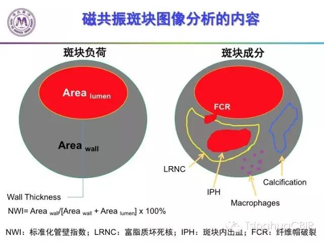 影像PPT - 颈动脉斑块磁共振图像的判读分析方法-2