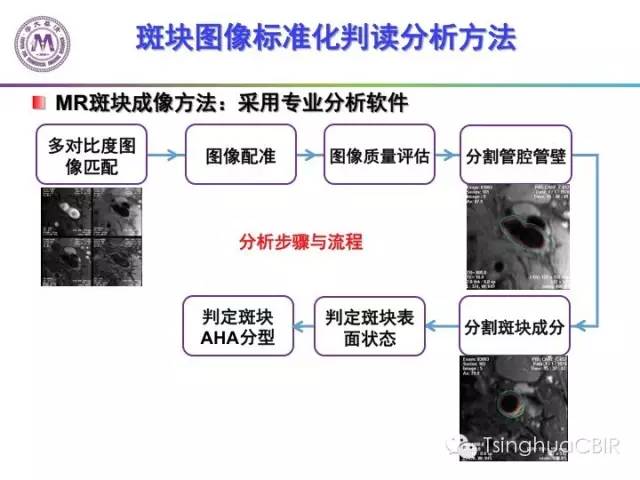 影像PPT - 颈动脉斑块磁共振图像的判读分析方法-4