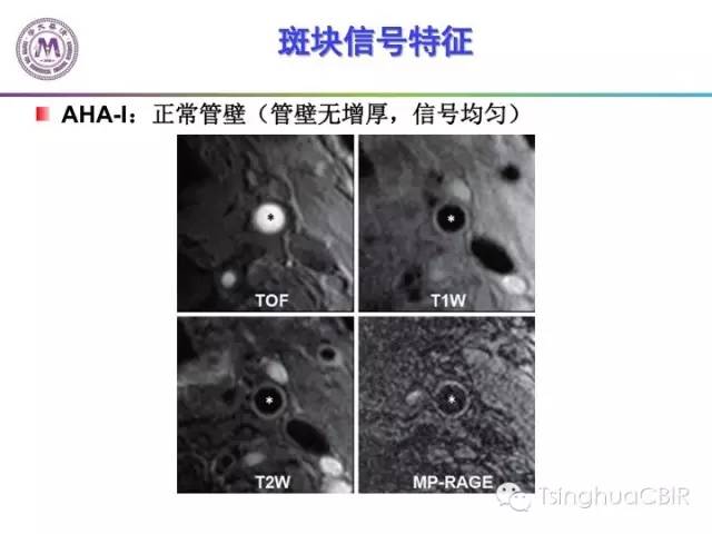 影像PPT - 颈动脉斑块磁共振图像的判读分析方法-8
