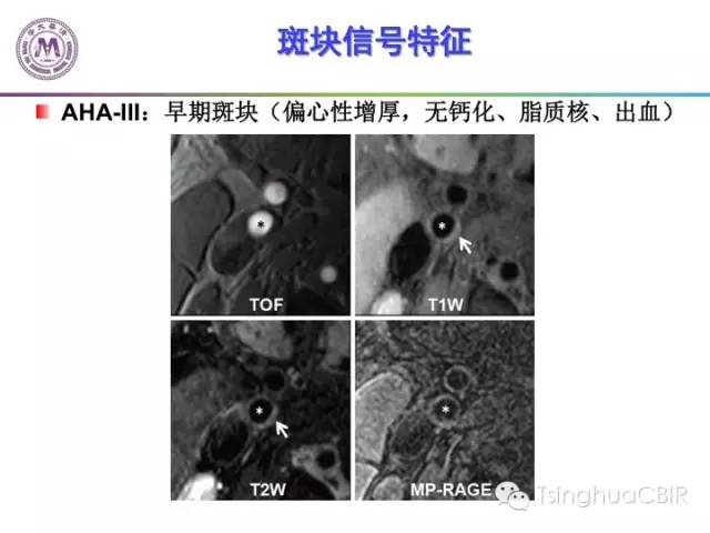 影像PPT - 颈动脉斑块磁共振图像的判读分析方法-9