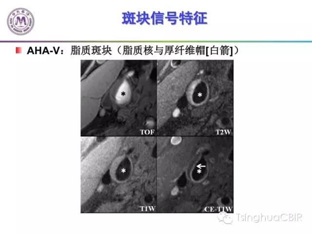 影像PPT - 颈动脉斑块磁共振图像的判读分析方法-10