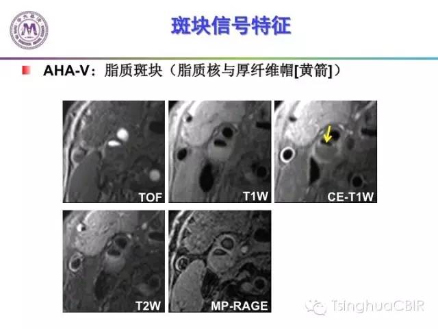 影像PPT - 颈动脉斑块磁共振图像的判读分析方法-11
