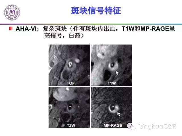 影像PPT - 颈动脉斑块磁共振图像的判读分析方法-12
