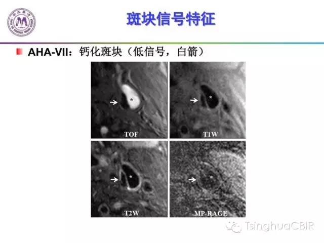 影像PPT - 颈动脉斑块磁共振图像的判读分析方法-13