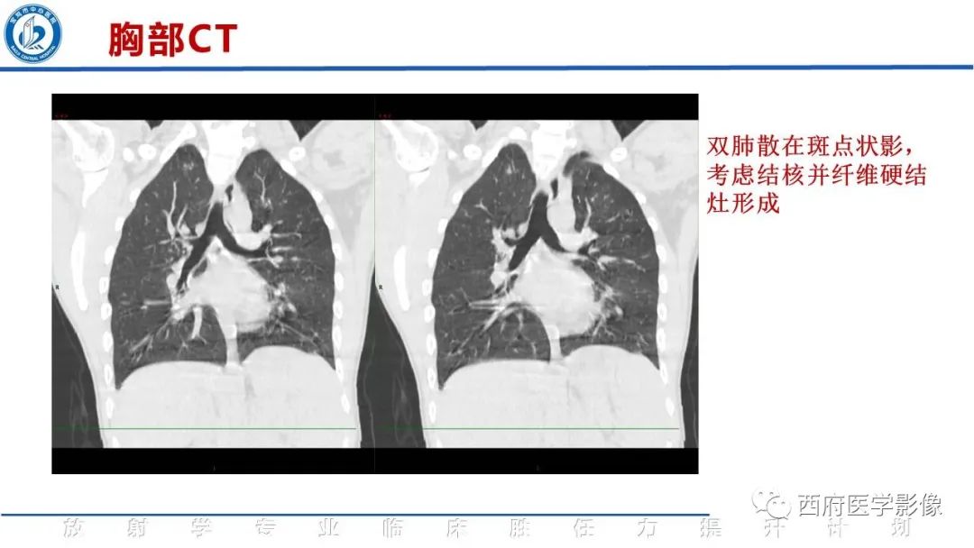 影像PPT - 【病例】脊柱结核腰椎结核1例MR影像表现与鉴别-7