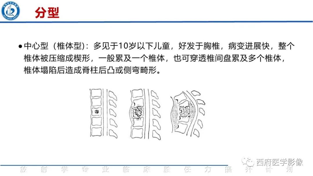影像PPT - 【病例】脊柱结核腰椎结核1例MR影像表现与鉴别-11