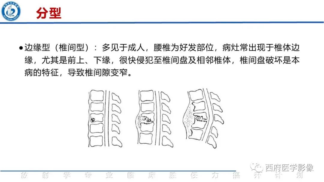 影像PPT - 【病例】脊柱结核腰椎结核1例MR影像表现与鉴别-12