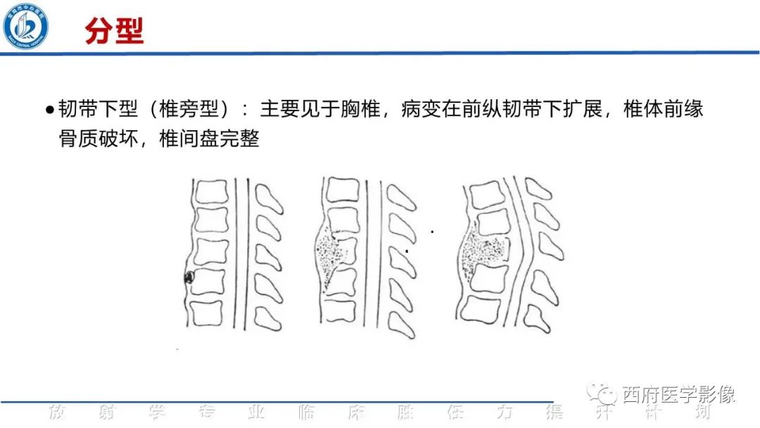 影像PPT - 【病例】脊柱结核腰椎结核1例MR影像表现与鉴别-13