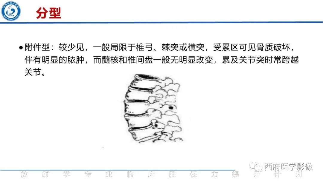 影像PPT - 【病例】脊柱结核腰椎结核1例MR影像表现与鉴别-14