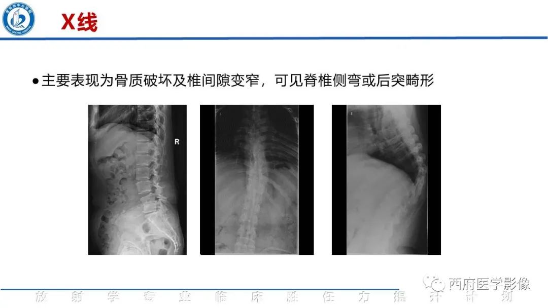 影像PPT - 【病例】脊柱结核腰椎结核1例MR影像表现与鉴别-20