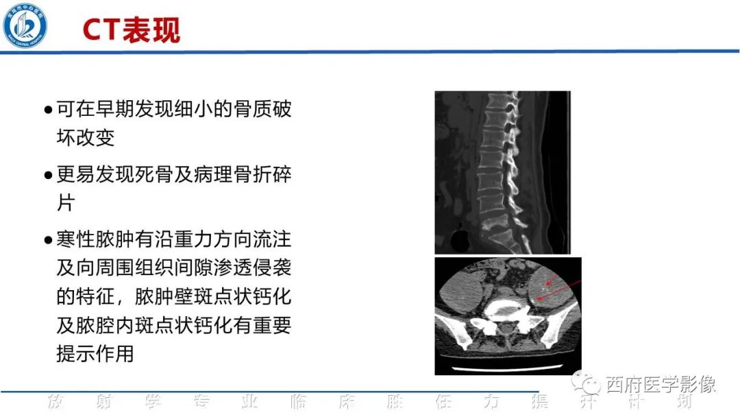 影像PPT - 【病例】脊柱结核腰椎结核1例MR影像表现与鉴别-21