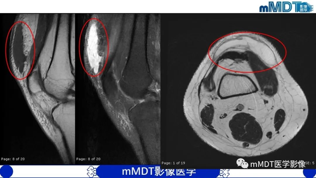 影像PPT - 【PPT】非肿瘤性前膝疼痛综合征MR评估—基于解剖层次视角-5 影像PPT - 【PPT】非肿瘤性前膝疼痛综合征MR评估—基于解剖层次视角-5