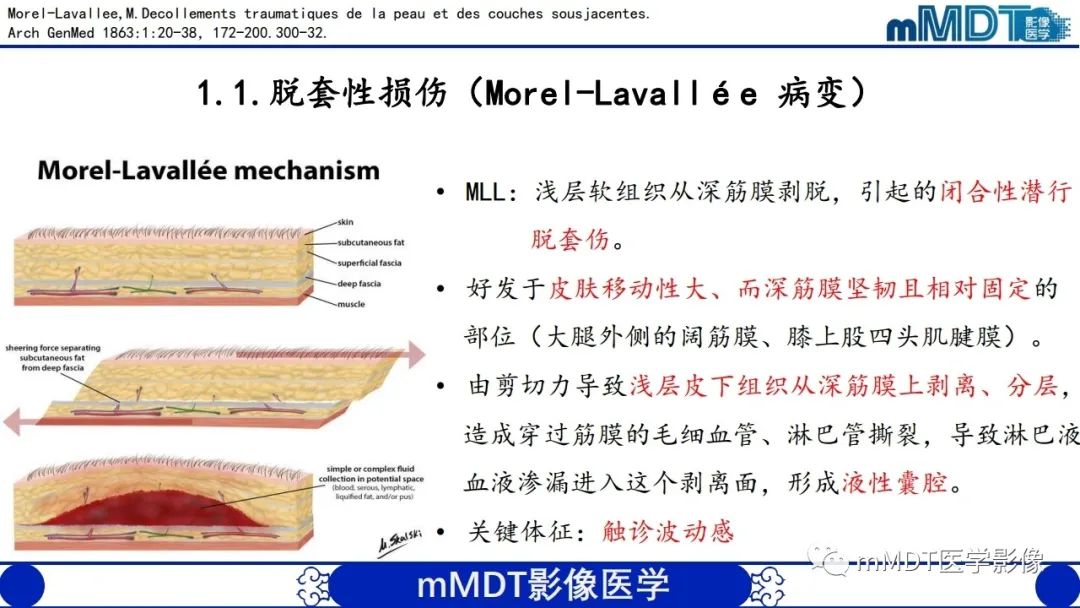 影像PPT - 【PPT】非肿瘤性前膝疼痛综合征MR评估—基于解剖层次视角-4 影像PPT - 【PPT】非肿瘤性前膝疼痛综合征MR评估—基于解剖层次视角-4