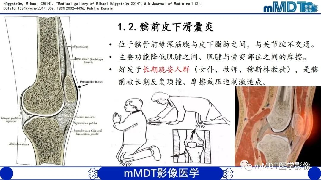 影像PPT - 【PPT】非肿瘤性前膝疼痛综合征MR评估—基于解剖层次视角-6 影像PPT - 【PPT】非肿瘤性前膝疼痛综合征MR评估—基于解剖层次视角-6