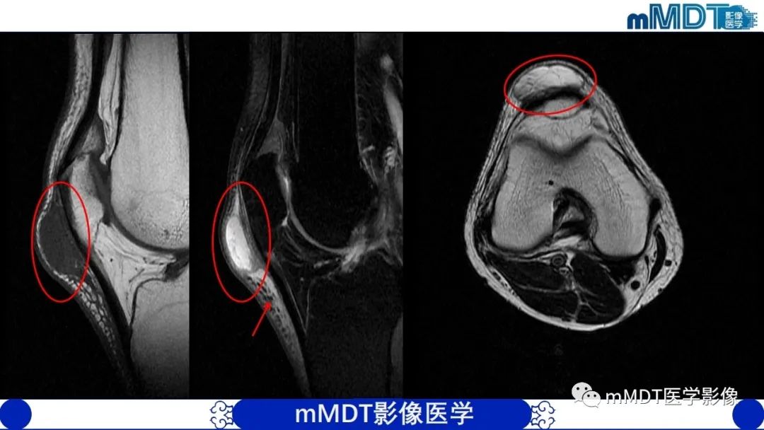 影像PPT - 【PPT】非肿瘤性前膝疼痛综合征MR评估—基于解剖层次视角-7 影像PPT - 【PPT】非肿瘤性前膝疼痛综合征MR评估—基于解剖层次视角-7