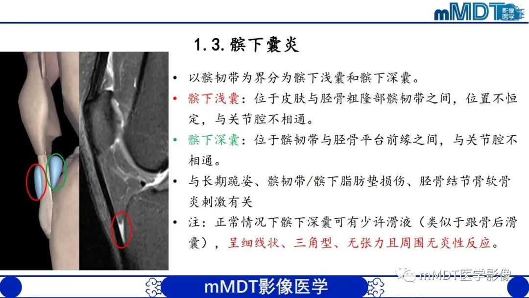 影像PPT - 【PPT】非肿瘤性前膝疼痛综合征MR评估—基于解剖层次视角-8 影像PPT - 【PPT】非肿瘤性前膝疼痛综合征MR评估—基于解剖层次视角-8