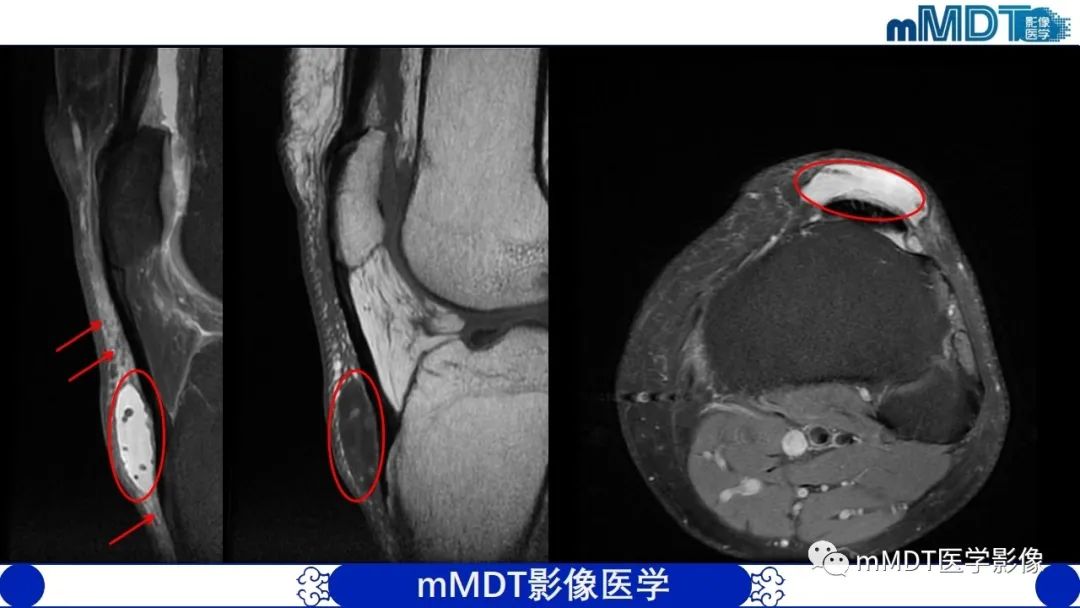 影像PPT - 【PPT】非肿瘤性前膝疼痛综合征MR评估—基于解剖层次视角-9 影像PPT - 【PPT】非肿瘤性前膝疼痛综合征MR评估—基于解剖层次视角-9