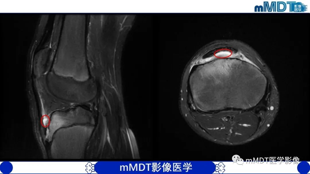 影像PPT - 【PPT】非肿瘤性前膝疼痛综合征MR评估—基于解剖层次视角-10 影像PPT - 【PPT】非肿瘤性前膝疼痛综合征MR评估—基于解剖层次视角-10