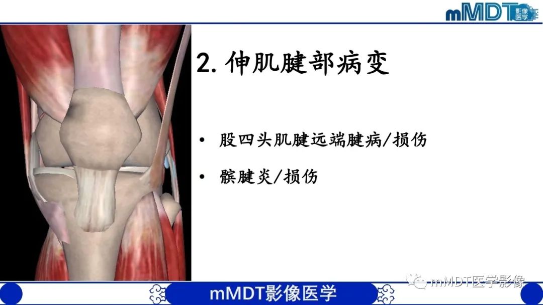 影像PPT - 【PPT】非肿瘤性前膝疼痛综合征MR评估—基于解剖层次视角-11 影像PPT - 【PPT】非肿瘤性前膝疼痛综合征MR评估—基于解剖层次视角-11
