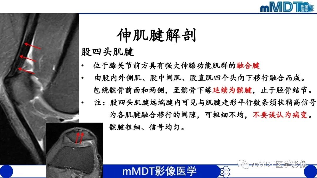 影像PPT - 【PPT】非肿瘤性前膝疼痛综合征MR评估—基于解剖层次视角-12 影像PPT - 【PPT】非肿瘤性前膝疼痛综合征MR评估—基于解剖层次视角-12