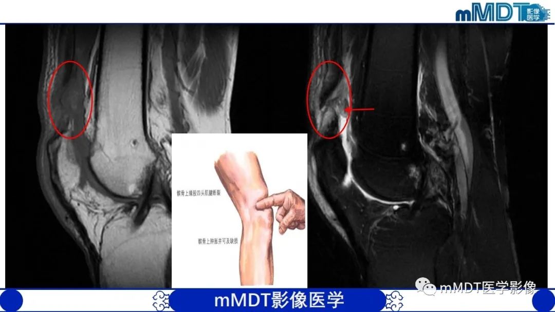 影像PPT - 【PPT】非肿瘤性前膝疼痛综合征MR评估—基于解剖层次视角-13 影像PPT - 【PPT】非肿瘤性前膝疼痛综合征MR评估—基于解剖层次视角-13