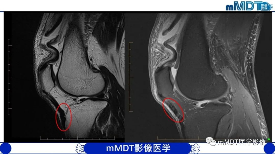 影像PPT - 【PPT】非肿瘤性前膝疼痛综合征MR评估—基于解剖层次视角-14 影像PPT - 【PPT】非肿瘤性前膝疼痛综合征MR评估—基于解剖层次视角-14