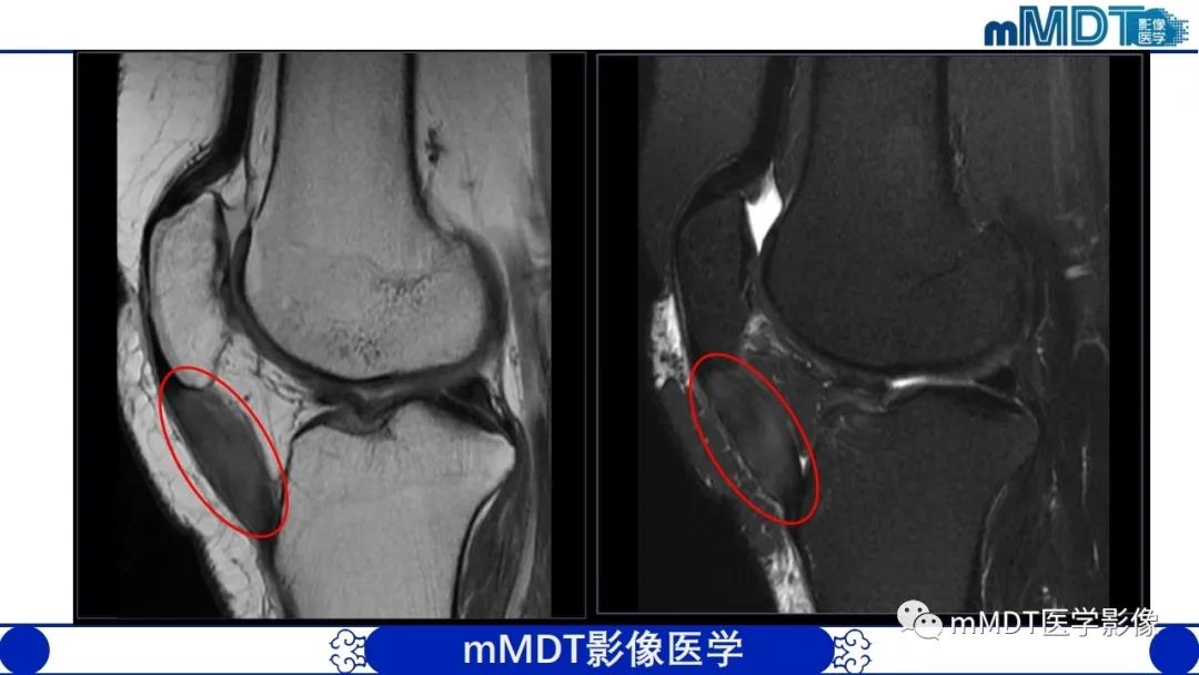 影像PPT - 【PPT】非肿瘤性前膝疼痛综合征MR评估—基于解剖层次视角-15 影像PPT - 【PPT】非肿瘤性前膝疼痛综合征MR评估—基于解剖层次视角-15
