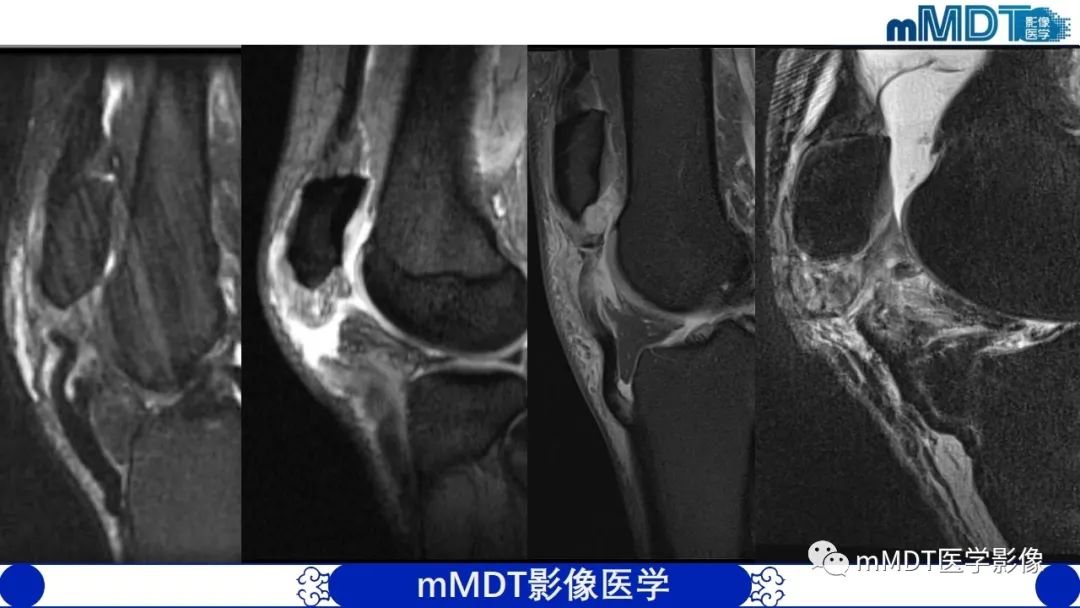 影像PPT - 【PPT】非肿瘤性前膝疼痛综合征MR评估—基于解剖层次视角-16 影像PPT - 【PPT】非肿瘤性前膝疼痛综合征MR评估—基于解剖层次视角-16