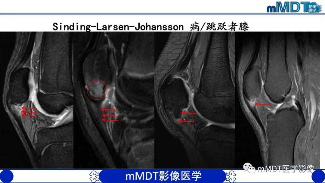 影像PPT - 【PPT】非肿瘤性前膝疼痛综合征MR评估—基于解剖层次视角-18 影像PPT - 【PPT】非肿瘤性前膝疼痛综合征MR评估—基于解剖层次视角-18
