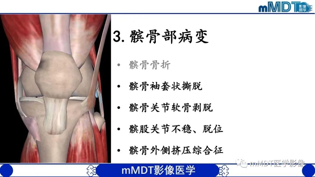 影像PPT - 【PPT】非肿瘤性前膝疼痛综合征MR评估—基于解剖层次视角-19 影像PPT - 【PPT】非肿瘤性前膝疼痛综合征MR评估—基于解剖层次视角-19