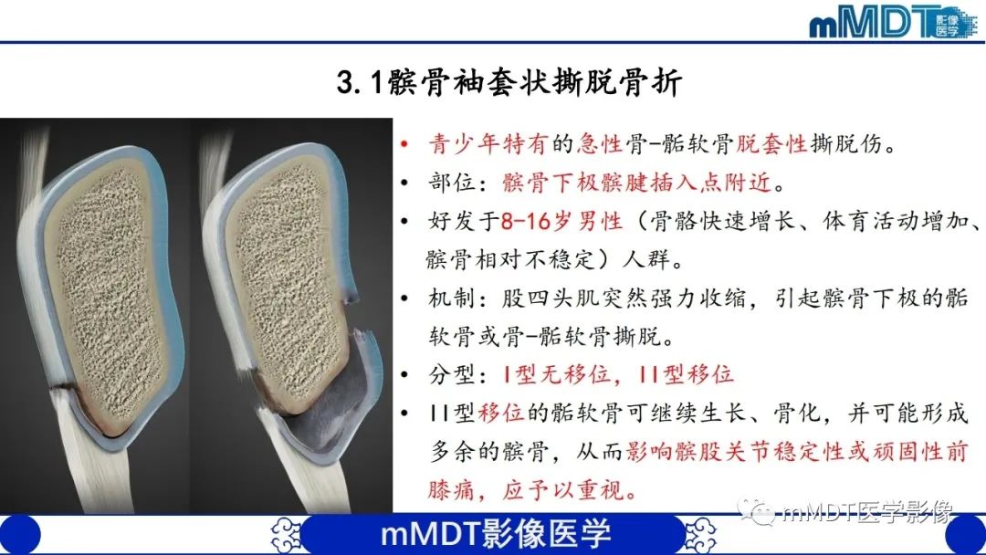 影像PPT - 【PPT】非肿瘤性前膝疼痛综合征MR评估—基于解剖层次视角-20 影像PPT - 【PPT】非肿瘤性前膝疼痛综合征MR评估—基于解剖层次视角-20