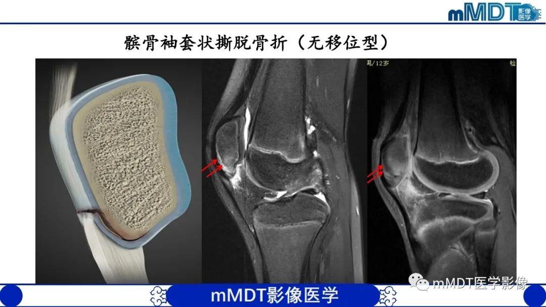 影像PPT - 【PPT】非肿瘤性前膝疼痛综合征MR评估—基于解剖层次视角-21 影像PPT - 【PPT】非肿瘤性前膝疼痛综合征MR评估—基于解剖层次视角-21