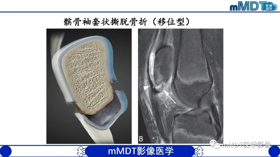 影像PPT - 【PPT】非肿瘤性前膝疼痛综合征MR评估—基于解剖层次视角-22 影像PPT - 【PPT】非肿瘤性前膝疼痛综合征MR评估—基于解剖层次视角-22