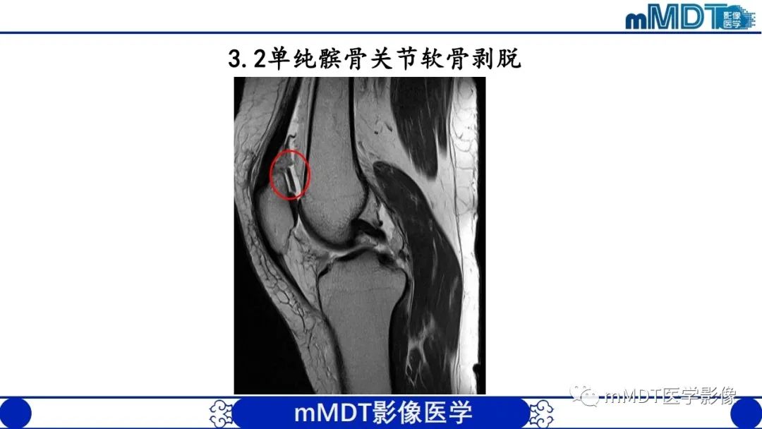 影像PPT - 【PPT】非肿瘤性前膝疼痛综合征MR评估—基于解剖层次视角-23 影像PPT - 【PPT】非肿瘤性前膝疼痛综合征MR评估—基于解剖层次视角-23