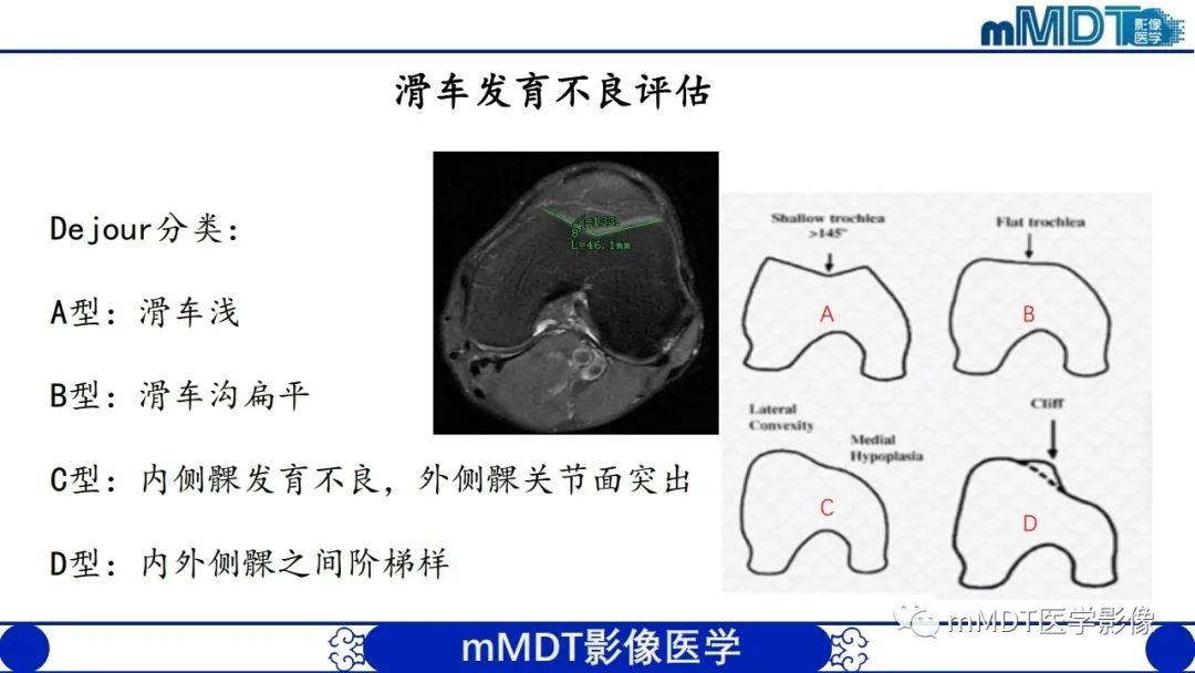影像PPT - 【PPT】非肿瘤性前膝疼痛综合征MR评估—基于解剖层次视角-24 影像PPT - 【PPT】非肿瘤性前膝疼痛综合征MR评估—基于解剖层次视角-24