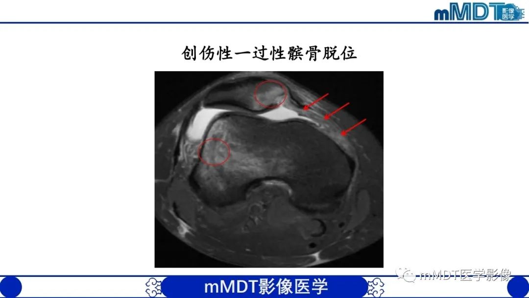 影像PPT - 【PPT】非肿瘤性前膝疼痛综合征MR评估—基于解剖层次视角-26 影像PPT - 【PPT】非肿瘤性前膝疼痛综合征MR评估—基于解剖层次视角-26