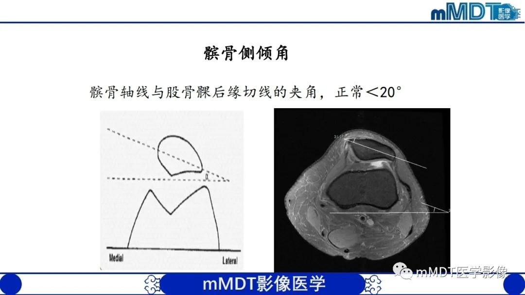 影像PPT - 【PPT】非肿瘤性前膝疼痛综合征MR评估—基于解剖层次视角-28 影像PPT - 【PPT】非肿瘤性前膝疼痛综合征MR评估—基于解剖层次视角-28