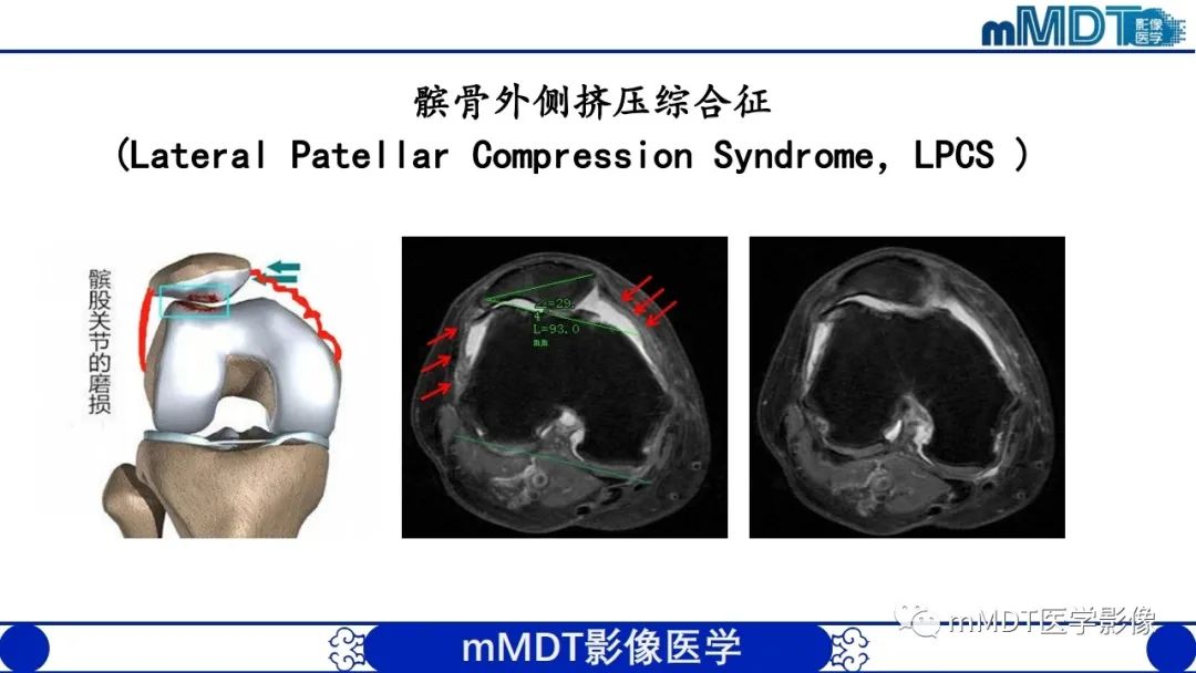 影像PPT - 【PPT】非肿瘤性前膝疼痛综合征MR评估—基于解剖层次视角-29 影像PPT - 【PPT】非肿瘤性前膝疼痛综合征MR评估—基于解剖层次视角-29