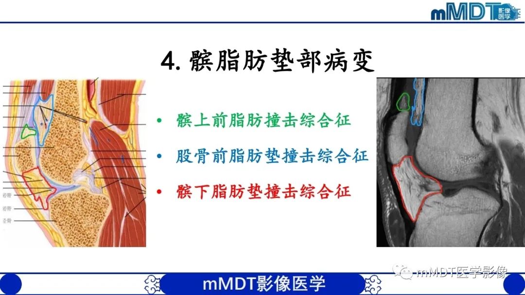 影像PPT - 【PPT】非肿瘤性前膝疼痛综合征MR评估—基于解剖层次视角-30 影像PPT - 【PPT】非肿瘤性前膝疼痛综合征MR评估—基于解剖层次视角-30