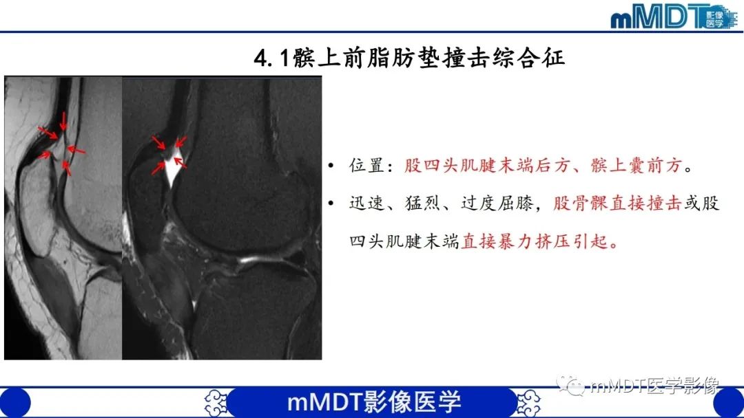 影像PPT - 【PPT】非肿瘤性前膝疼痛综合征MR评估—基于解剖层次视角-31 影像PPT - 【PPT】非肿瘤性前膝疼痛综合征MR评估—基于解剖层次视角-31