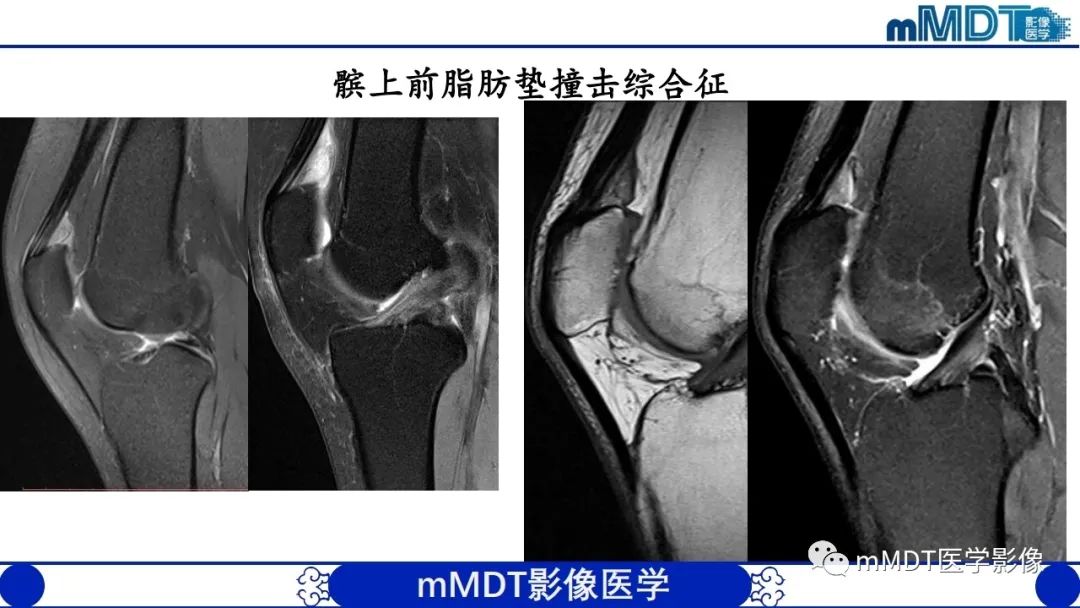 影像PPT - 【PPT】非肿瘤性前膝疼痛综合征MR评估—基于解剖层次视角-32 影像PPT - 【PPT】非肿瘤性前膝疼痛综合征MR评估—基于解剖层次视角-32