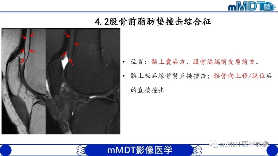 影像PPT - 【PPT】非肿瘤性前膝疼痛综合征MR评估—基于解剖层次视角-33 影像PPT - 【PPT】非肿瘤性前膝疼痛综合征MR评估—基于解剖层次视角-33